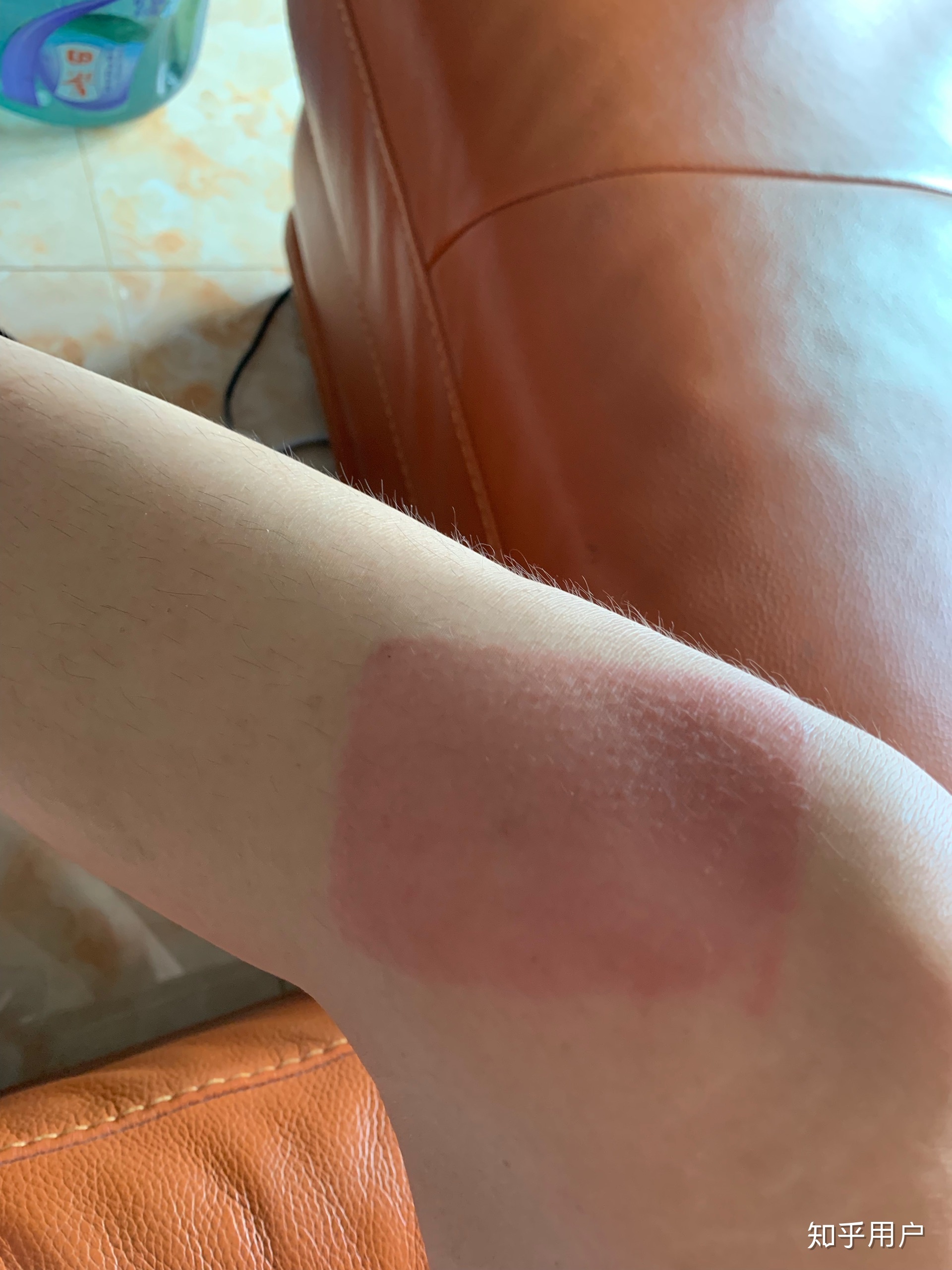 2、貼膏藥的地方有很多紅疙瘩，好不好？