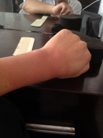 3、膏藥過敏的妙招是什么？